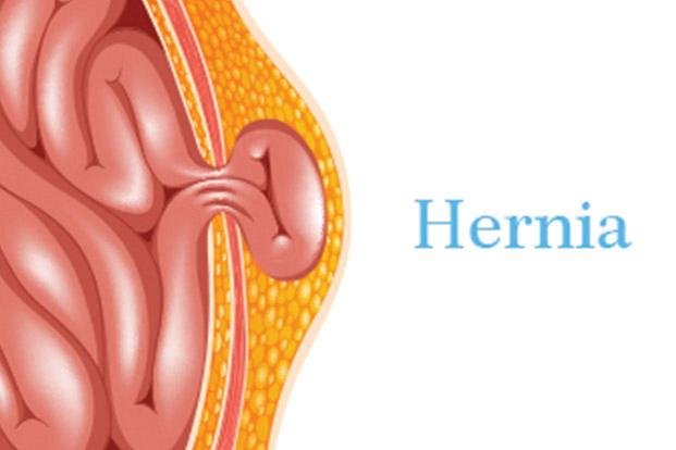 Hernia Surgery