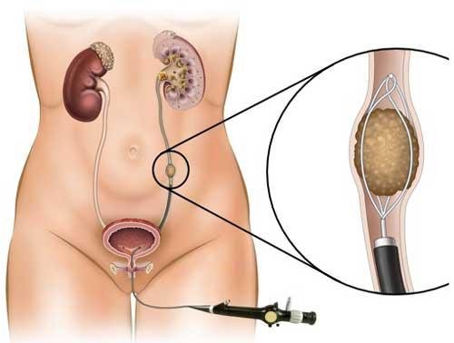 Stone & Prostate Surgery
